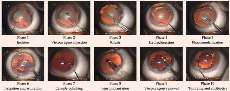 Steps of a cataract surgery. Cataract is removed and Intraocular lens (IOL) delivered to the eye using IOL injectors. Hydrophilic coatings for IOL injectors, coated on the inside of the cartridge help provider smoother and safer delivery.