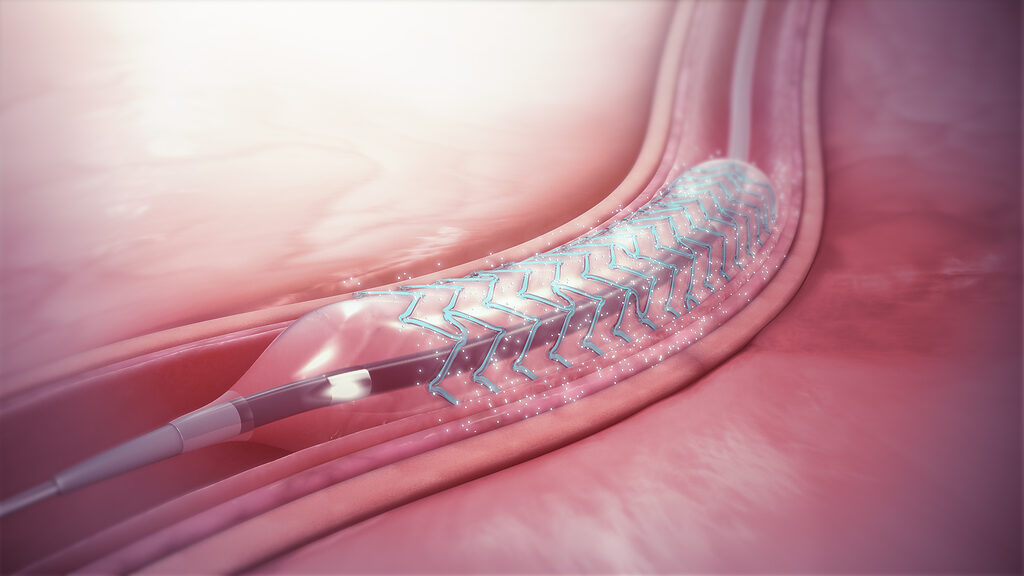 drug eluting stent with coating