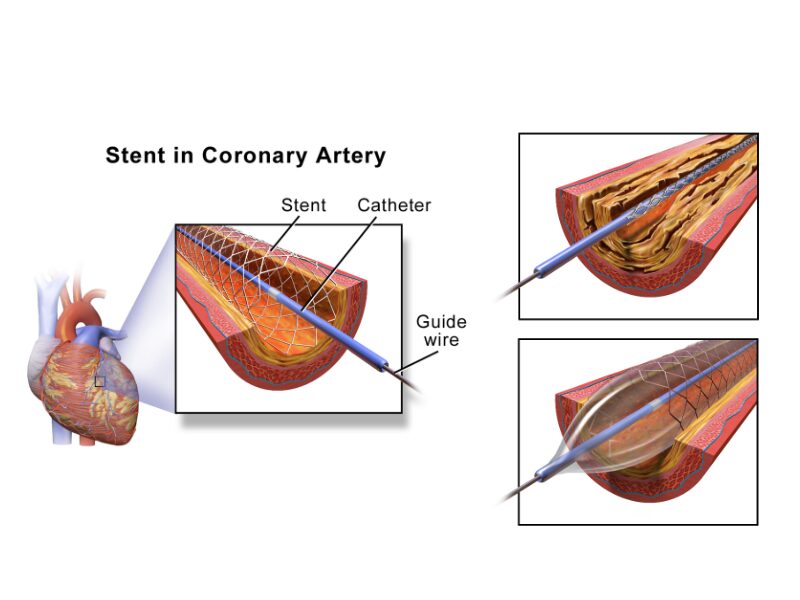 Stent in coronary artery, balloon inflated with stent.